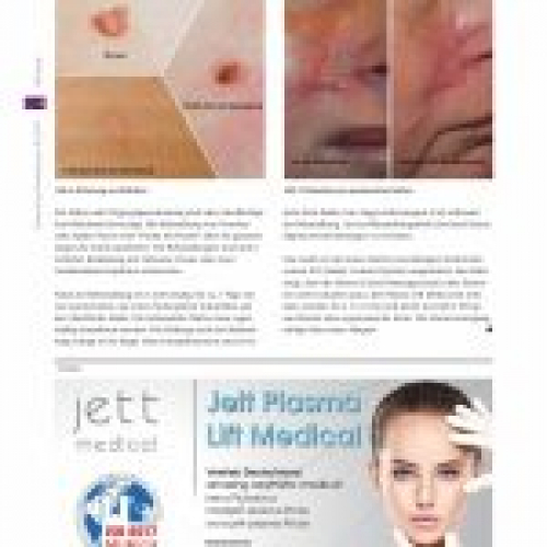 Ästhetische Dermatologie - Jett-Plasma-Lift-Medical-in-german-media-page-003-150x150.jpg